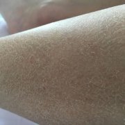 鱼鳞病的危害怎么样