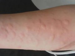 常如何预防过敏的方法