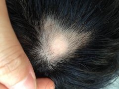 斑秃要注意什么事项