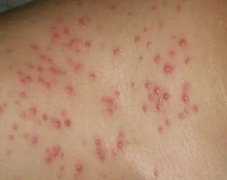 毛囊炎症状表现有哪些